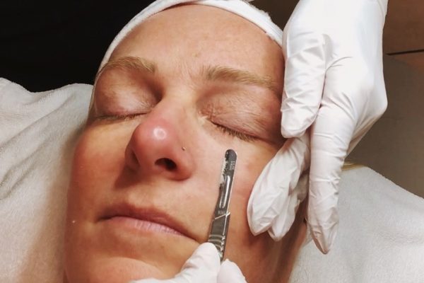 person closing eyes for dermplaning treatment